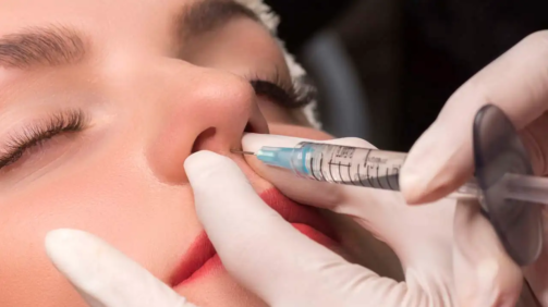 Los resultados de la rinoplastia con ácido hilaurónico son inmediatos, pero temporales