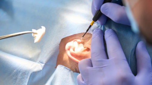 Las técnicas de operación de oído endoscópicas permiten una recuperación rápida y con molestias reducidas