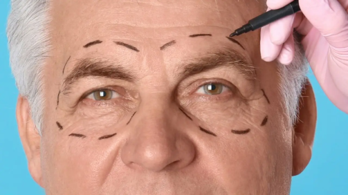 La operación de blefaroplastia es la cirugía estética más realizada por hombres en España