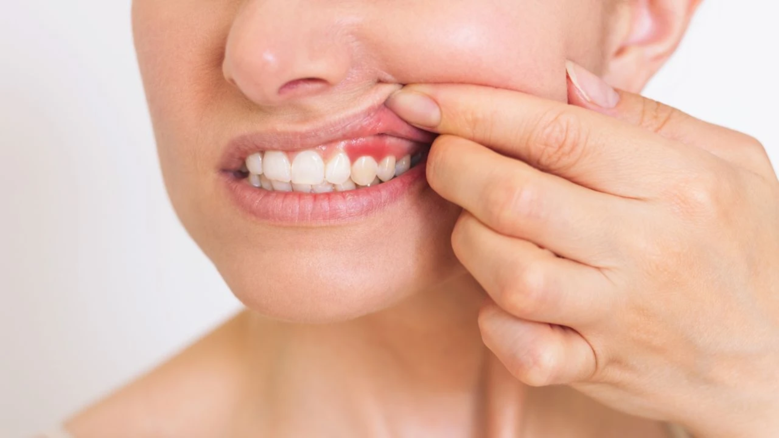 Las infecciones dentales pueden pasar de la encía superior a los senos paranasales y provocar una sinusitis maxilar