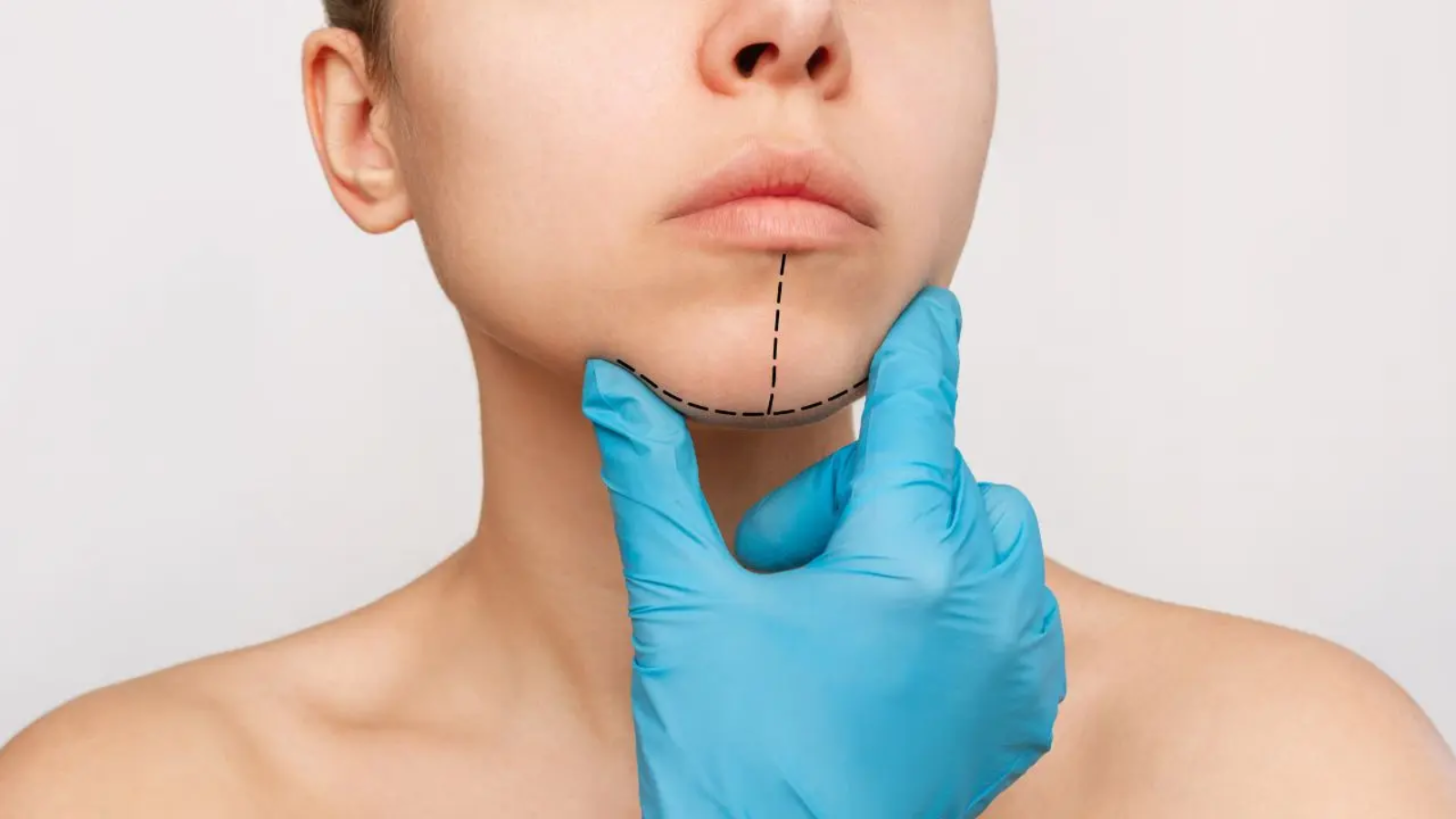 La operación de mentón es un tipo de cirugía facial que modifica el aspecto de la barbilla