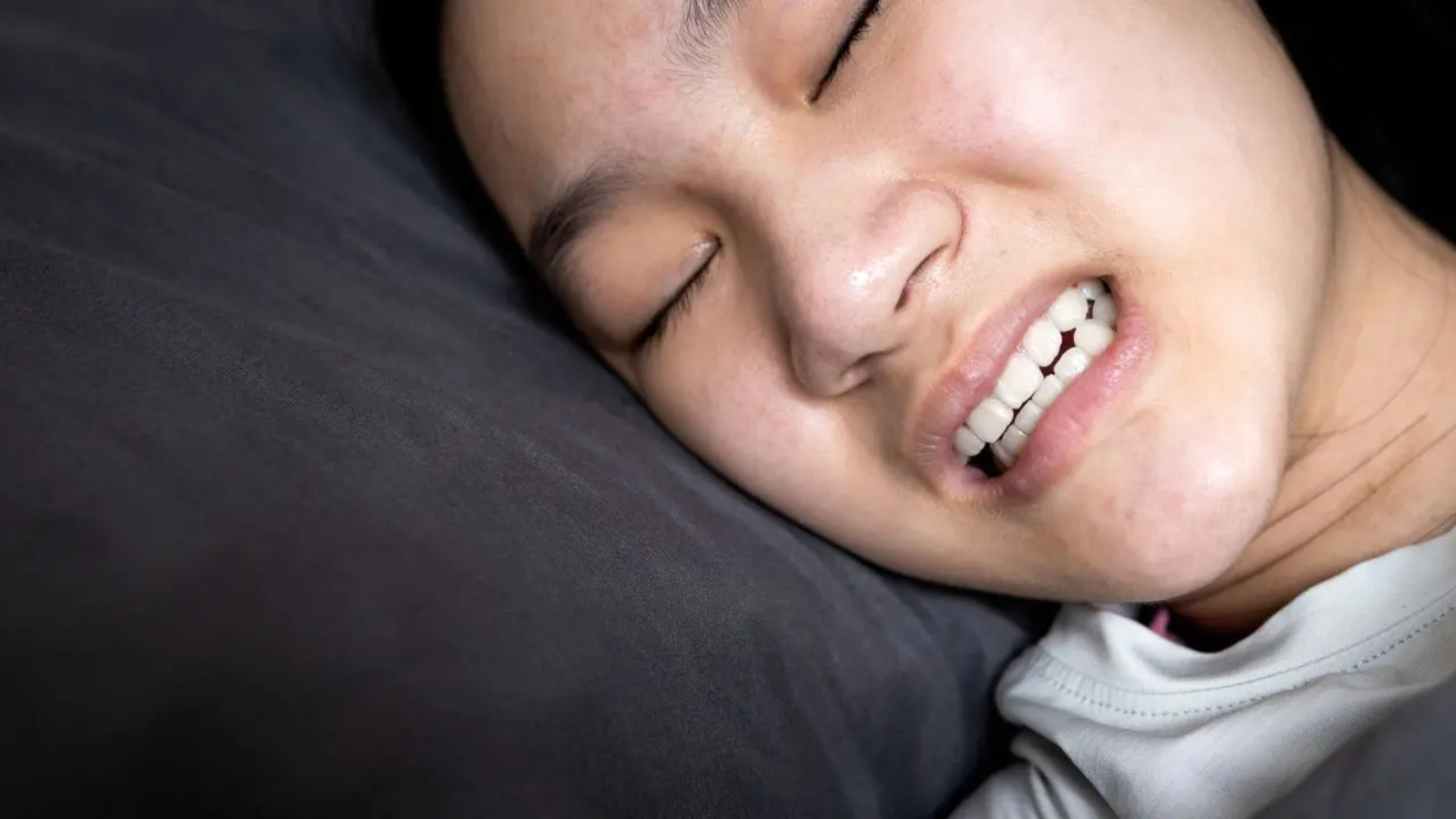 La relación entre bruxismo, apnea del sueño y desgaste dental queda de manifiesto en casos con el de la mujer de la imagen
